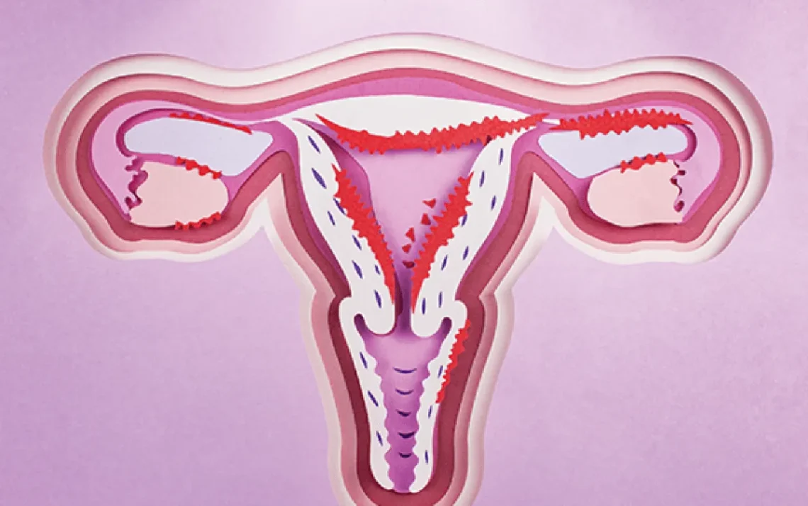 cancer, uterino, carcinoma, endometrial;