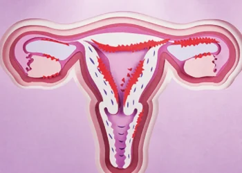 cancer, uterino, carcinoma, endometrial;