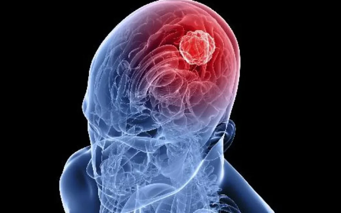 vacina contra glioblastoma, vacina personalizada, vacina promissor, vacina clínica ensaios, nova vacina;