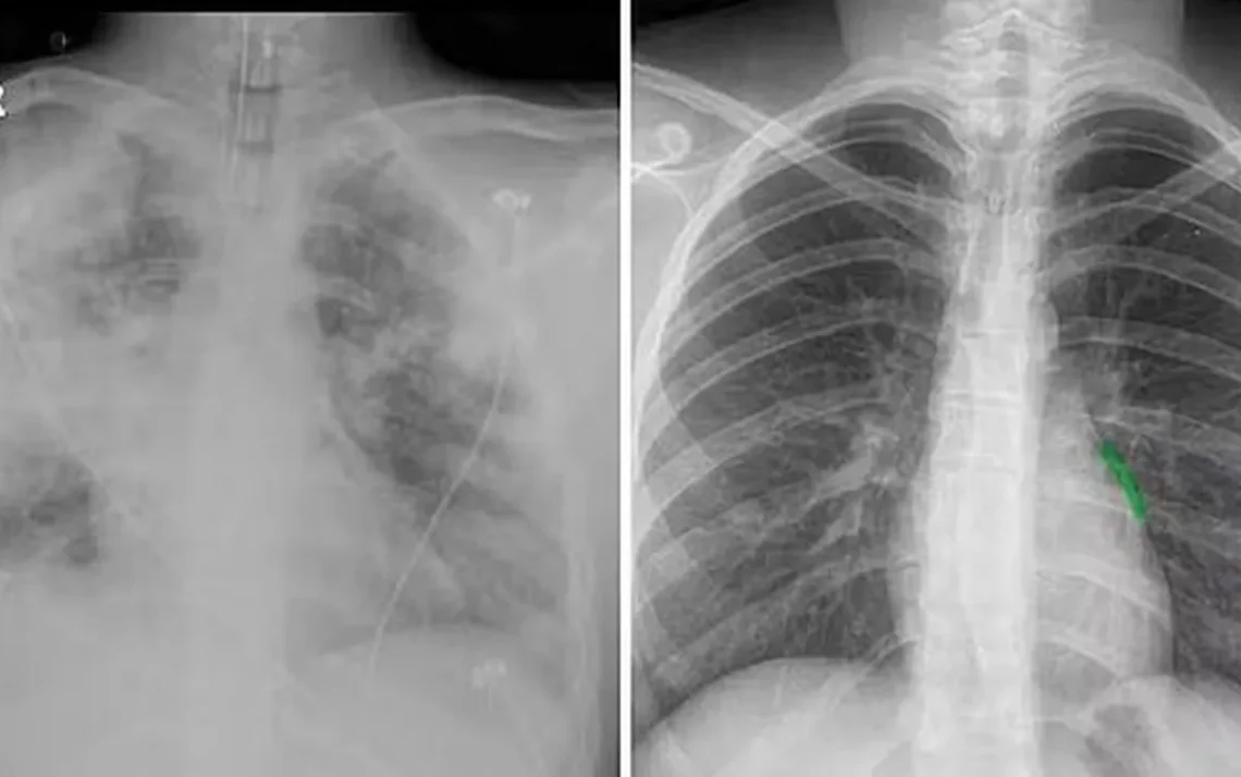 embolia pulmonar, infarto pulmonar, enfisema pulmonar;