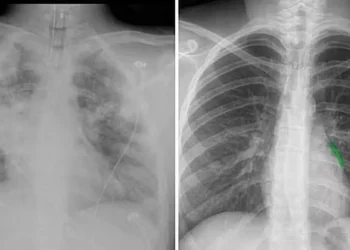 embolia pulmonar, infarto pulmonar, enfisema pulmonar;