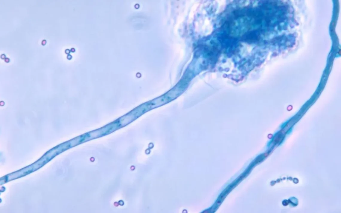 aspergilose pulmonar, aspergillus, esporos, conídios, fungo, infecção, sistema imune debilitado, imunodeficiência, doenças infecciosas;