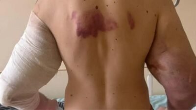 Influenciador pode perder os braços após injeções de óleo nos bíceps