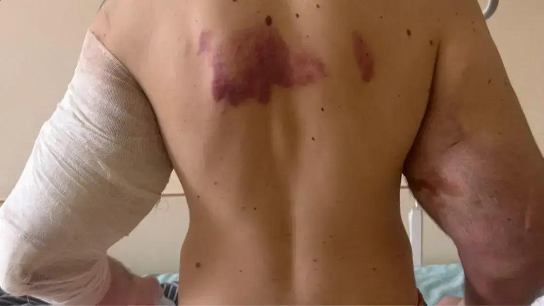 Influenciador pode perder os braços após injeções de óleo nos bíceps