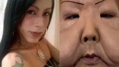 Juju do Pix se submete a cirurgia para retirar óleo mineral do rosto