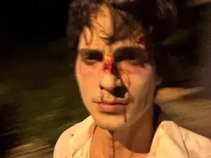 Fiuk causa preocupação ao postar foto com rosto machucado no Instagram