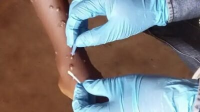 Brasil tem 88 casos confirmados de mpox em 2026; SP lidera com 62