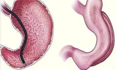 Gastroplastia endoscópica: redução do estômago sem cirurgia invasiva