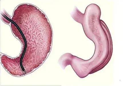 Gastroplastia endoscópica: redução do estômago sem cirurgia invasiva
