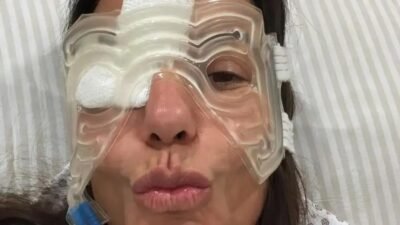 Ivete Sangalo recebe alta e comenta inchaço no rosto após cirurgia