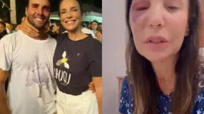 Ivete Sangalo tem cirurgia facial bem-sucedida e previsão de alta