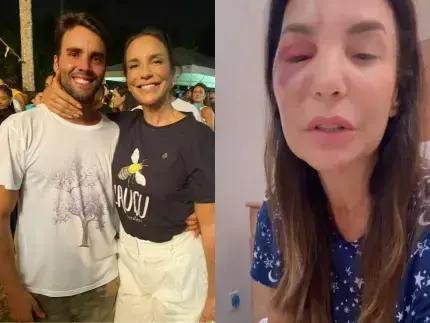 Ivete Sangalo tem cirurgia facial bem-sucedida e previsão de alta