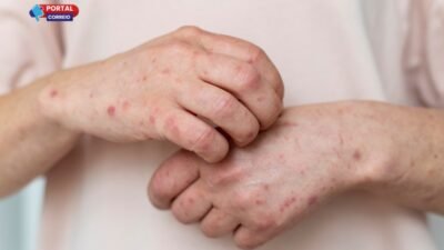 Dermatite Atópica no Inverno: aprenda a aliviar e prevenir as crises na pele