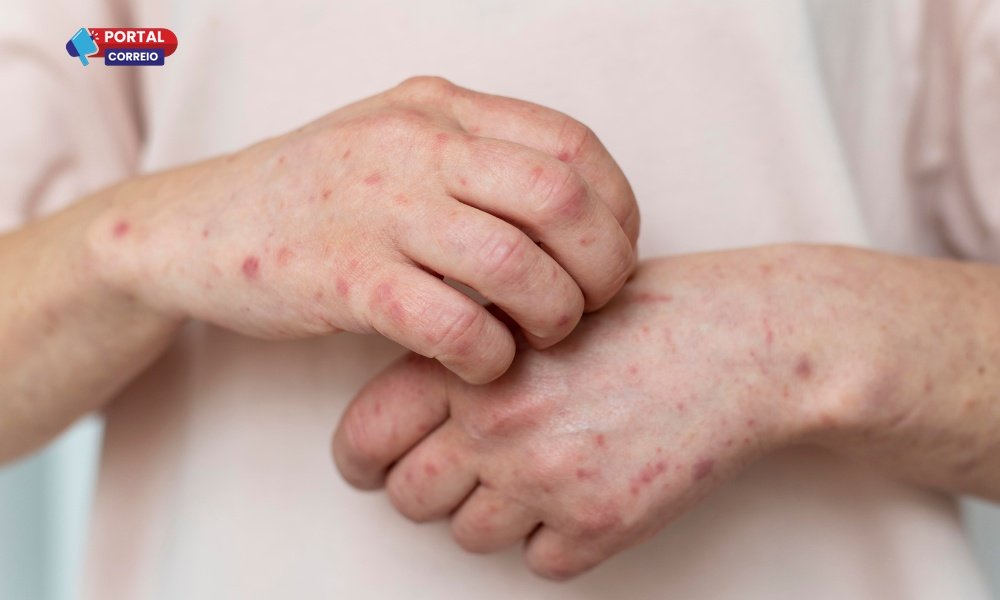 Dermatite Atópica no Inverno: aprenda a aliviar e prevenir as crises na pele